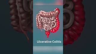 Understanding Crohns Disease vs Ulcerative Colitis [upl. by Cornelle]