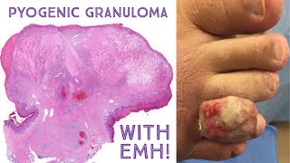 HUGE Pyogenic Granuloma lobular capillary hemangioma  extramedullary hematopoiesis Emory case 6 [upl. by Lebar]