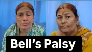 Bell’s Palsy Patient Review Recovery Dr Pritam Singh  Jigars physiotherapist [upl. by Ocer977]