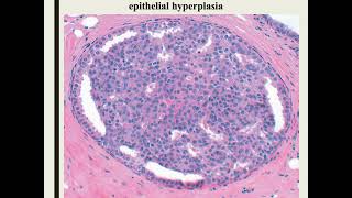 benign epithelial lesions of the breast [upl. by Nelra]