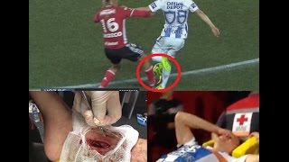 Terrible Lesión del CHUCKY Lozano  Horrible Injury [upl. by Dorran]