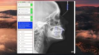 Tutorial 8  Radiografías II trazado de cefalometría [upl. by Chainey]