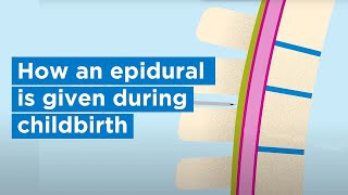 How an epidural is given during childbirth  Bupa Health [upl. by Vig]