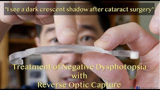 Why do I see a shadow crescent or arc after cataract surgery Treatment of Negative Dysphotopsia [upl. by Narih228]