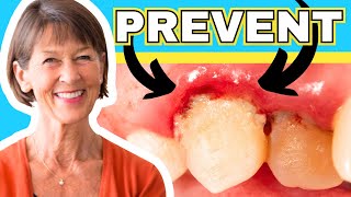 How To Treat Gingivitis And Gum Recession At Home [upl. by Itraa]