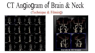 CT Angiogram of Brain and neck technique and filming [upl. by Bart]