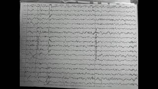 Paroxysmal epileptiform activity in eeg of a child with medication refractory epilepsy [upl. by Massimo166]