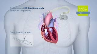 Biotronik pacemaker EVIA [upl. by Irrabaj]