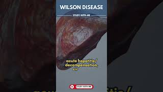 HealthByte Wilson Disease  A medical minute [upl. by Nahoj394]