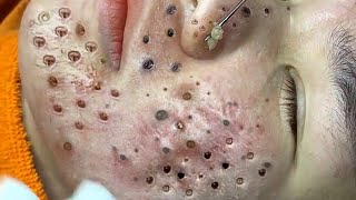 Loan Nguyen Acne Treatment 2245hn [upl. by Tshombe427]