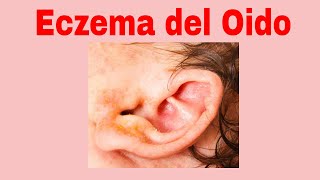 Eczema del Oido  Causas  Sintomas  Tratamiento [upl. by Vittorio]