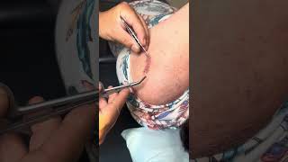 how to remove surgical sutures  continuous sutures [upl. by Aneehsar]