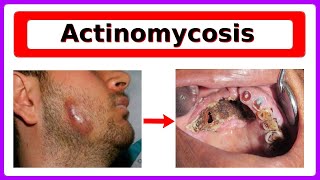 actinomycosis [upl. by Aniluap575]