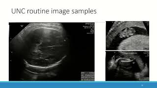 US FAMLI Automated Measurement of fetal biometry [upl. by Nort27]