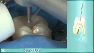 Pulp Chamber Access with Riitano Access Burs Kit [upl. by Chlores]