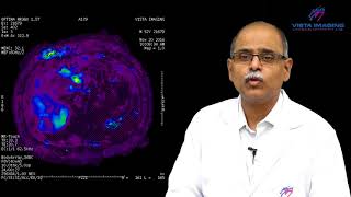 MR Elastography for Liver diseseas [upl. by Ida]