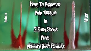 How To Remove Pulp Tissue in 3 Easy Steps from Primary Root Canal  pulpectomy  step by step [upl. by Clerk]