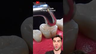 Tooth Extraction The ACTUAL Process Explained [upl. by Botti]