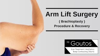 Brachioplasty  Arm Lift Surgery  Procedure and Recovery [upl. by Paza536]