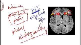 Video 217 Overview of Demyelinating Disorders Clinical Features Diagnostics and Risk Factors [upl. by Wobniar]