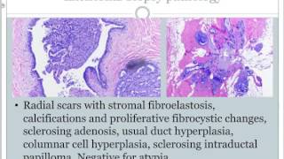 2017 Breast Webinar 1  High Risk Proliferative Lesions [upl. by Ayanej693]