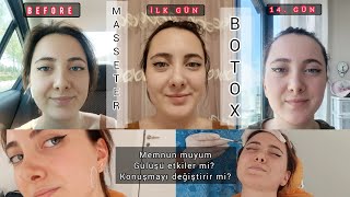 MASSETER BOTOX YAPTIRDIM  ETKİLERİ NELER   1 AYLIK SÜREÇ [upl. by Aihk883]