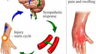 Complex Regional Pain Syndrome CRPS [upl. by Enatan]