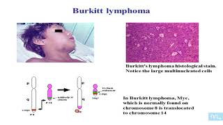 Virus et Lymphomes partie 11 lymphome de Burkitt [upl. by Namwob]