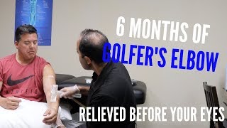 6 Months of Golfers Elbow Relieved Before Your Eyes REAL RESULTS [upl. by Yenreit]