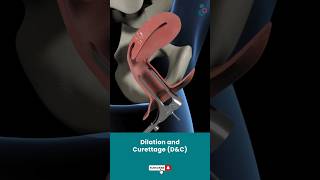 Dilation And Curettage DampC  Fertility Treatment ↪3D Medical Animation Shorts DilationampCurettage [upl. by Natalia]