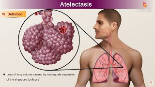 Atelectasis  Etiology Clinical Features Pathology pathophysiology Diagnosis and Treatment [upl. by Teerell]