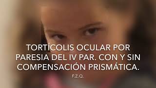 Tortícolis ocular en paresia del IV par Con y sin compensación prismática [upl. by Notle]