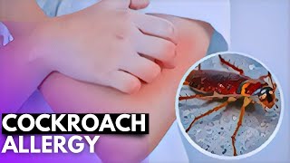 Cockroach Allergy Unmasked Symptoms Diagnosis and Treatment [upl. by Boeschen]