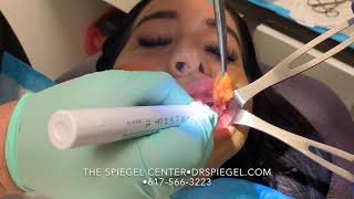 Buccal Fat Removal at The Spiegel Center [upl. by Selry]