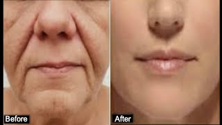 HOW TO REMOVE DEEP MOUTH WRINKLES REALLY FAST [upl. by Irep]