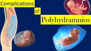 Complications of Polyhydramnios [upl. by Columbus]