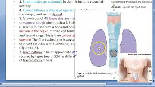 ENT Tracheostomy technique steps [upl. by Cristian]