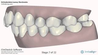 Invisalign Clincheck adulte Orthodontiste Lemay Sherbrooke NM48 143234 [upl. by Pestana126]