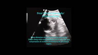 Dandy Walker Spectrum Disorder  Fetal Hydrocephalus  Fetal Ventriculomegaly [upl. by Foy]