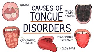 Understanding Tongue Disorders Causes and Management [upl. by Alver]