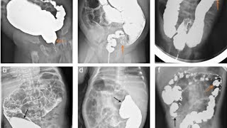 Barium Enema  Single and Double part 2 [upl. by Ennalorac]