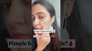 Pimple before periods solution  Period acne skincare acne shorts [upl. by Ause455]