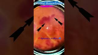 Retinal Hemorrhages  Eales disease  Fundus Photography  Short Video 93 science [upl. by Eskill]