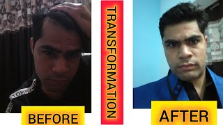 MY HAIR REGROWTH JOURNEY BEFORE AFTER hairgrowth hairregrowth dermaroller minoxidil [upl. by Ylrbmik]