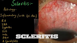 SCLERITIS in easiest way  Part 1 [upl. by Enileme]