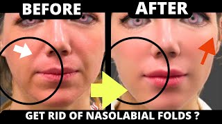 FACE YOGA FOR LAUGH LINES  NASOLABIAL FOLDS SAGGY SKIN JOWLS GET RID OF WRINKLES SAGGY CHEEKS [upl. by Tudela]