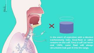 Subglottic aspiration of a tracheal cannula  Animation  Andreas Fahl MedizintechnikVertrieb GmbH [upl. by Harl262]