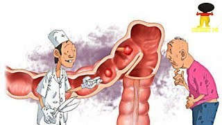 Colitis ulcerosa – Diagnose und Behandlung [upl. by Venator]