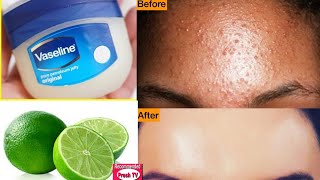 How To Remove Pimples Overnight  Acne Treatment Get rid of pimples overnight Vaseline and Lemon [upl. by Apollo]