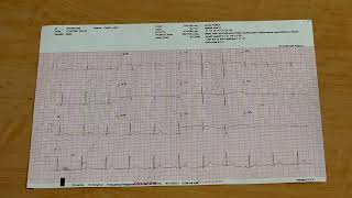 How to do a 15 Lead ECG [upl. by Abil]